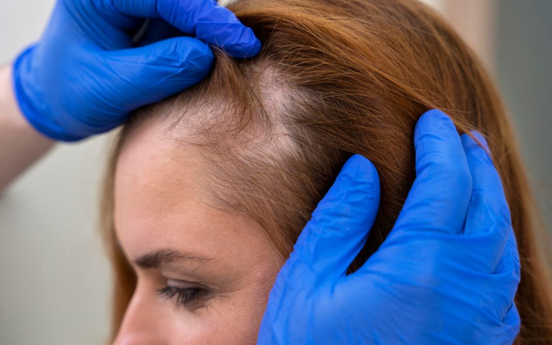 FUE czy FUT? Jak wybrać najlepszą metodę przeszczepu włosów dla siebie?