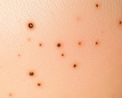 Zaskórniki: Przyczyny powstawania i skuteczne metody leczenia