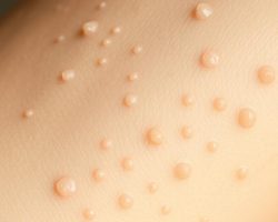 Rogowacenie okołomieszkowe – objawy, leczenie i skuteczne metody pielęgnacji