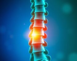 Przepuklina dysku: objawy, przyczyny i metody leczenia