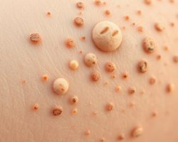 Kurzajki: objawy, przyczyny i skuteczne metody leczenia