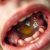 Stany ropne w jamie ustnej – objawy, przyczyny i leczenie