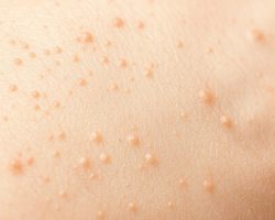 Rogowacenie okołomieszkowe – przyczyny, objawy i leczenie