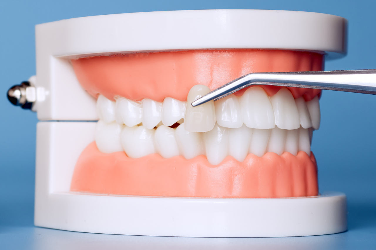 korona porcelanowa zębów gdańsk